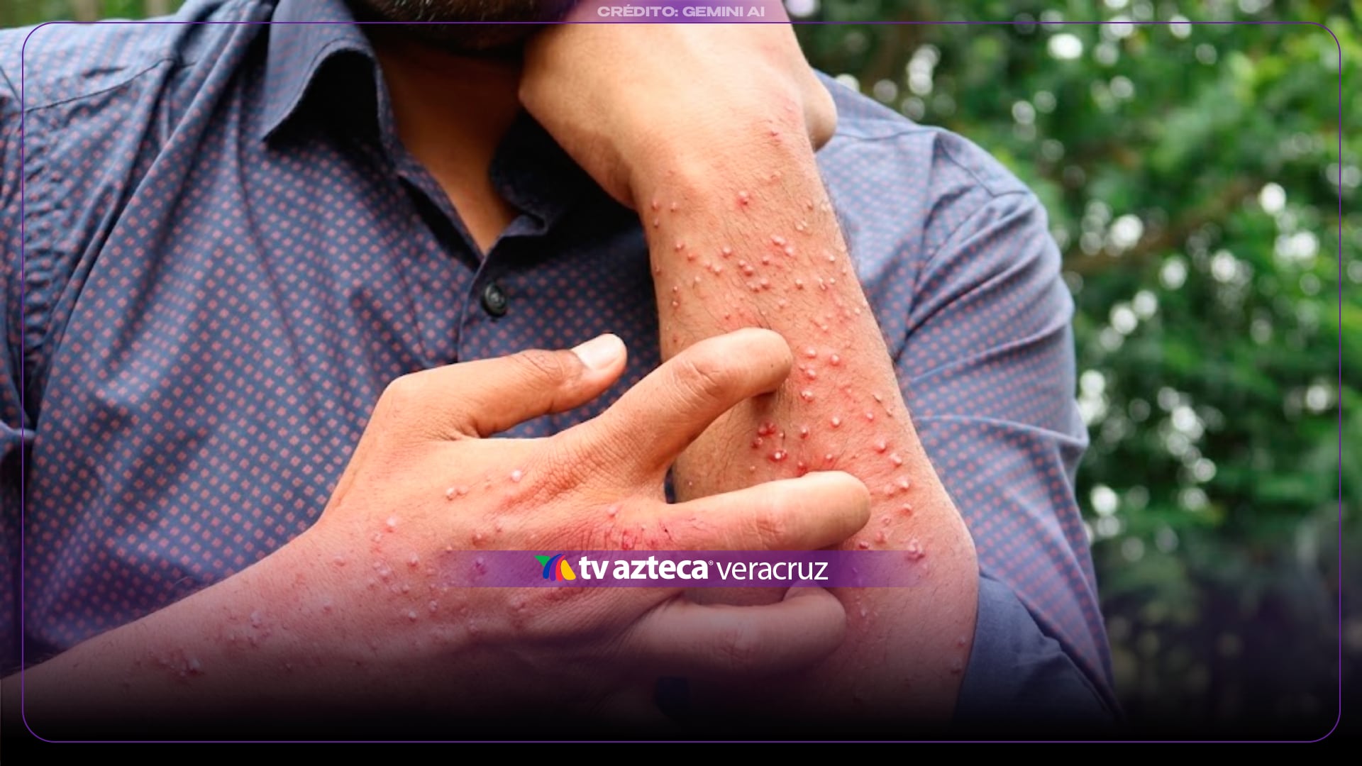 ¡No son pelitos enterrados! Podrías adquirir CONTAGIOSO BROTE por visitar MOTELES en Veracruz