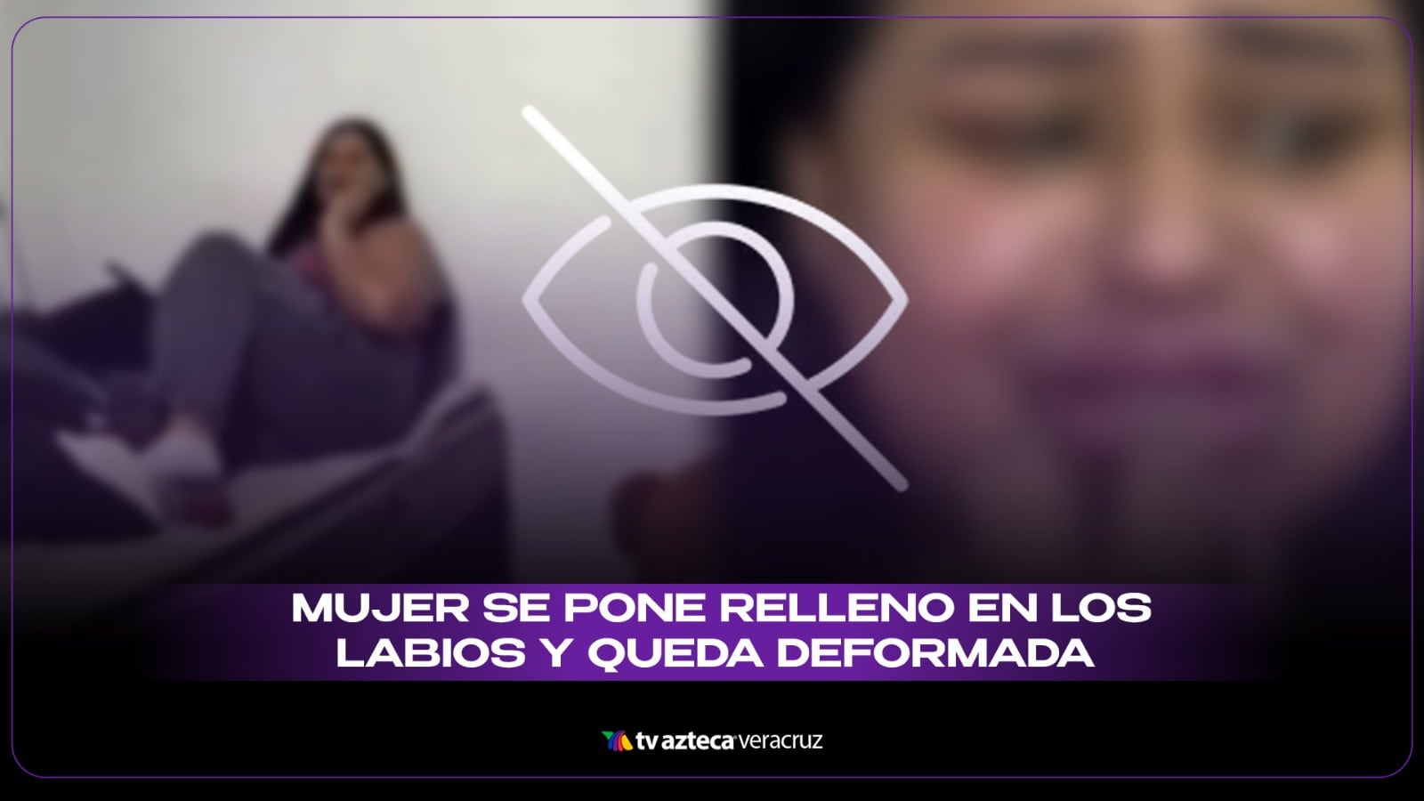 El arreglito facial no salió como esperaba y la mujer quedó deforme de sus labios.