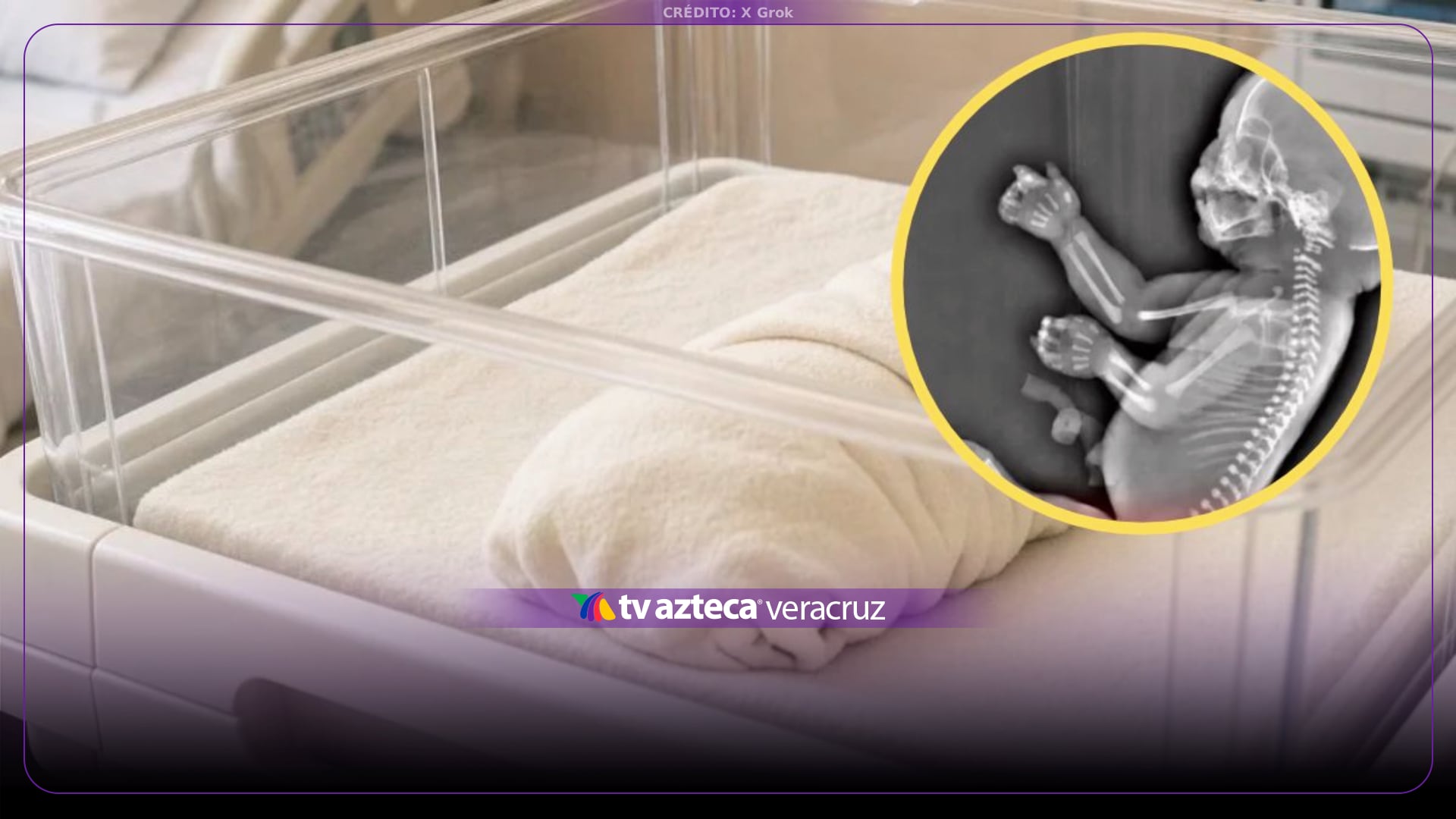 ¿Nació sin piernas? Detectan SÍNDROME de sirena en bebé; esto se sabe (+FOTO)